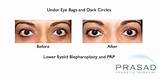 Prp Eye Treatment Images
