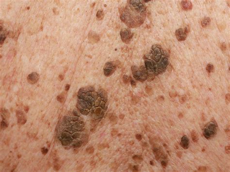 Seborrheic Keratosis Condition Treatments And Pictures For Adults