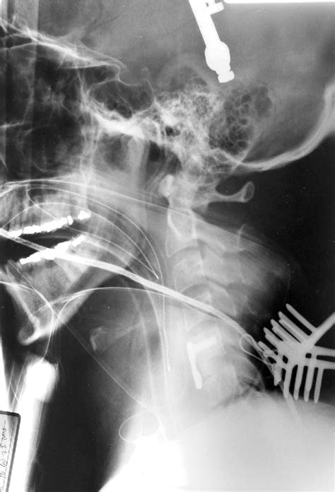 Irreducible Dislocations Of The Cervical Spine With A Prolapsed Disc