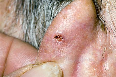 Basal Cell Carcinoma Stock Image M1310667 Science Photo Library