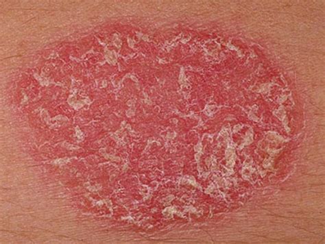 Plaque Psoriasis Pictures Treatment Symptoms And Causes Hubpages