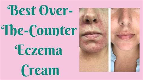 Best Over The Counter Eczema Cream Eczema Cream Eczema Remedies