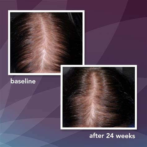 Other, less common minoxidil side effects include acne, inflammation around the hair roots, facial hair growth, acne, swelling around the face and even increased hair loss, in some cases. Amazon.com: Women's Rogaine 2% Minoxidil Topical Solution ...