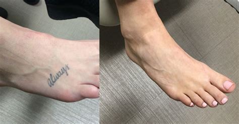 Laser Tattoo Removal Before And After Southeastern Dermatology