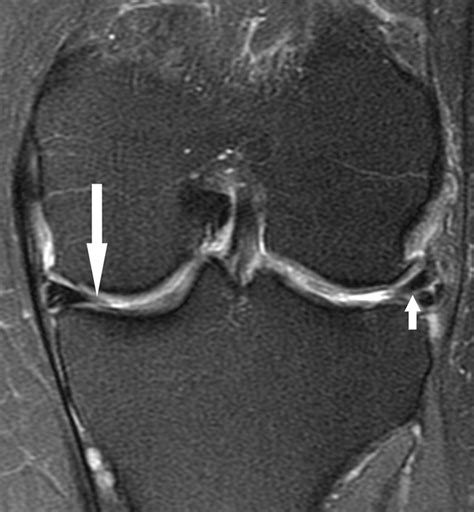 Accuracy Of 3 T Mri Using Fast Spin Echo Technique To Detect Meniscal