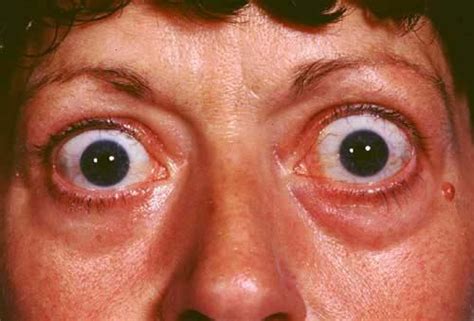 The Causes And Possible Course Of Treatment For Bulging Eyes
