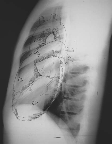 Anatomy Of Chest X Ray Normal Chest X Ray Litfl Medical Blog Labelled