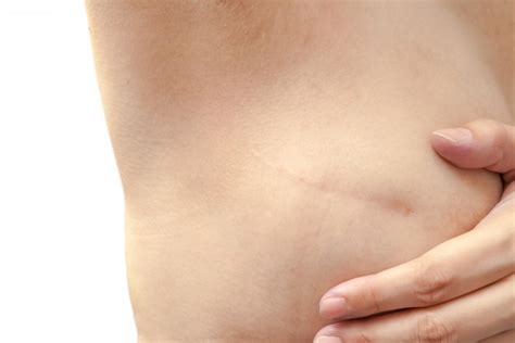 Mastectomy Scars Treatment Options And What To Expect