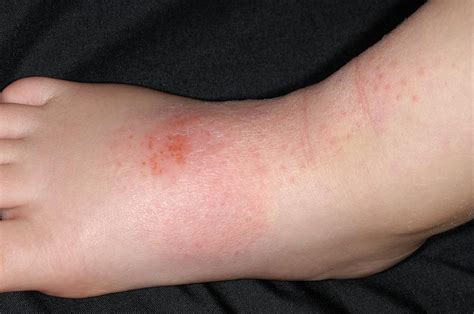Atopic Eczema Photograph By Dr P Marazziscience Photo Library