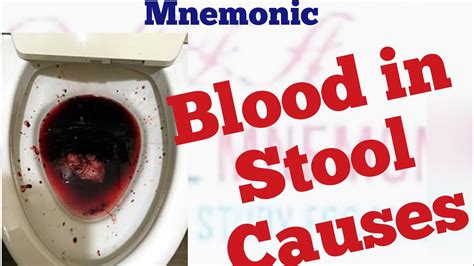 Causes Of Blood In Stool Mnemonic Youtube