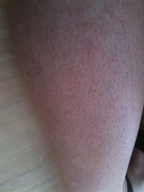 Ive Had A Rash For A Couple Of Weeks Now On My Arms And Legs