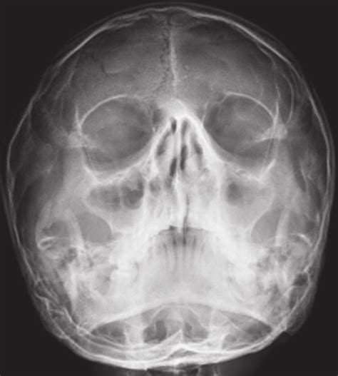 x ray of paranasal sinuses showing bilateral maxillary sinusitis with download scientific