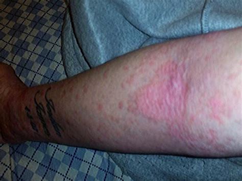 Bleach Bath Burns Mums Horrific Injuries After Alleged Skin Care
