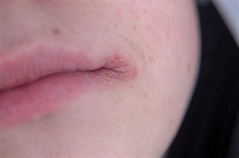 5 Products To Help You Manage Lip Eczema