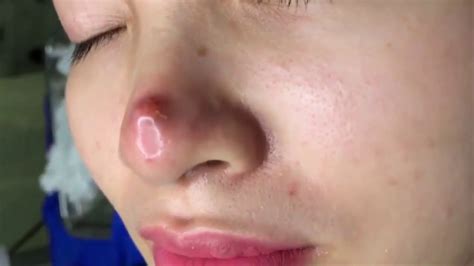 Big Infected Acne Removal On Nose Zoomx2 Youtube