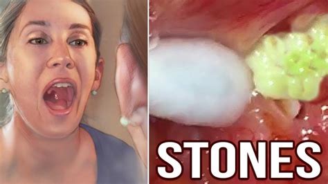 Removing Tonsil Stones At Home Compilation Youtube