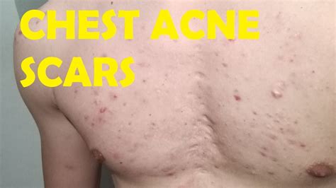 Will Chest Acne Scars Ever Go Away Youtube
