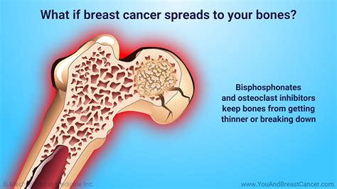 Slide Show Understanding Metastatic Breast Cancer