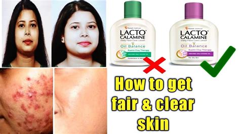 Lacto Calamine Lotion Reviewusesbenefitshow To Get Clear And Fair