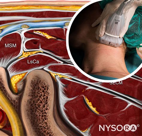 Ultrasound Guided Cervical Plexus Nerve Block Nysora Nysora