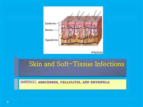 Ppt Skin And Soft Tissue Infections Powerpoint Presentation Free