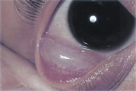 Conjunctival Epithelial Inclusion Cyst American Academy Of Ophthalmology