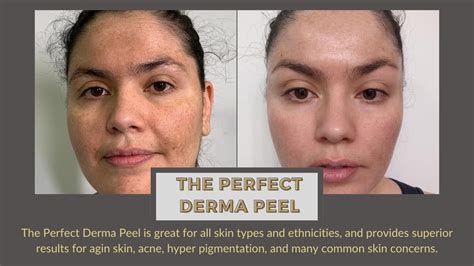 The Perfect Derma Peel Before And After At Brow Down Studio Los