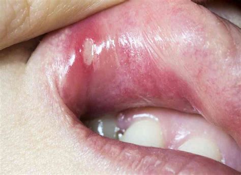 Mouth Ulcers Causes Symptoms Types Treatment