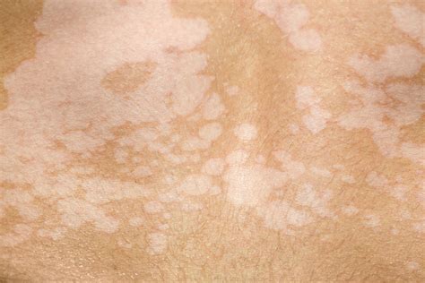 Ketoconazole For Tinea Versicolor