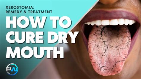 Xerostomia Dry Mouth Remedy And Treatment To Cure The Symptoms And Causes Of Xerostomia Youtube