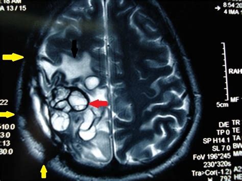 Multiple Cerebral Hydatid Cysts Have The Previous Operations