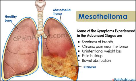 Other, rarer types of mesothelioma affect tissue in the abdomen (peritoneal mesothelioma), around the heart and around the testicles. Mesothelioma: Emerging Treatment, Symptoms, Causes, Types
