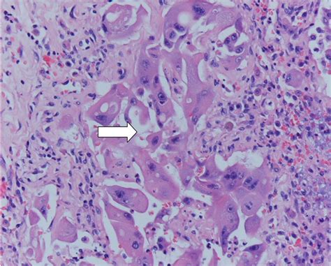 The most common prostate problem in dogs is a condition called benign prostatic hyperplasia (bph). Canine Prostate Carcinoma: Four Clinical Cases in Sexually ...