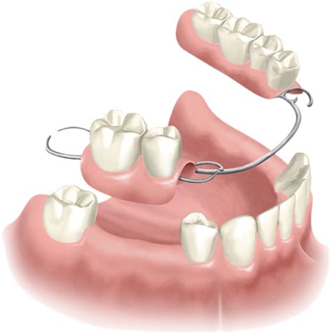 Removable Partial Denture Upper