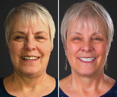 Dental implants often change older people's lives for the better, giving them improved physical health and more confidence. Affordable Senior Dental Implants | Dream Dental | Salt ...
