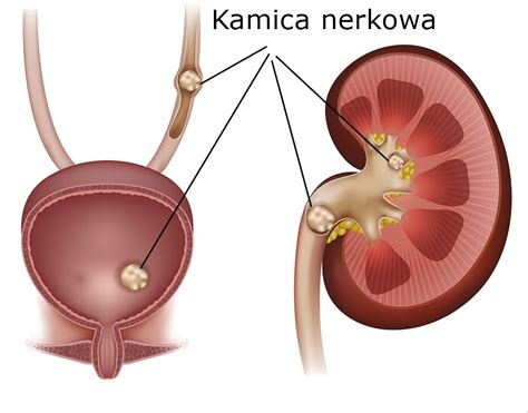 Kamica Nerkowa Objawy I Leczenie ALFA LEK