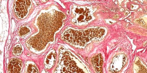 The main vessels that carry the blood to the head, neck and forelegs originate from the arch named as brachiocephalic trunk. Researchers connect brain blood vessel lesions to ...