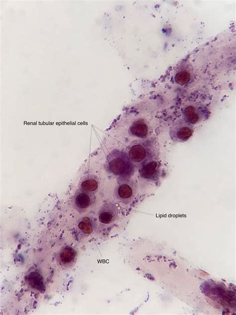 Renal Epithelial Cells In Urine