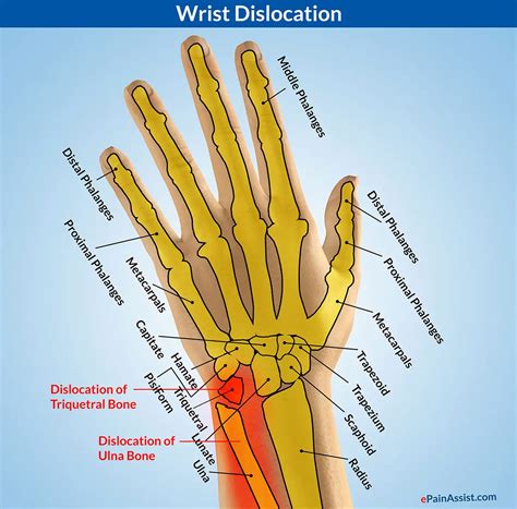 Wrist Dislocationtypescausessignssymptomstreatmentexercises