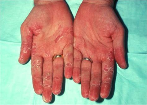 Psoriasis On Palm Of Hands Best Practices To Soothe Symptoms