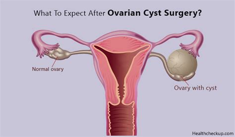 What To Expect After Ovarian Cyst Surgery Health Checkup