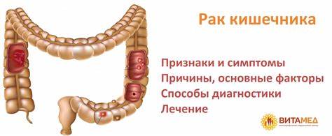 Диета при раке прямой кишке