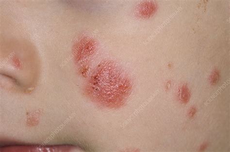 Psoriasis On The Face Stock Image C0029651 Science Photo Library