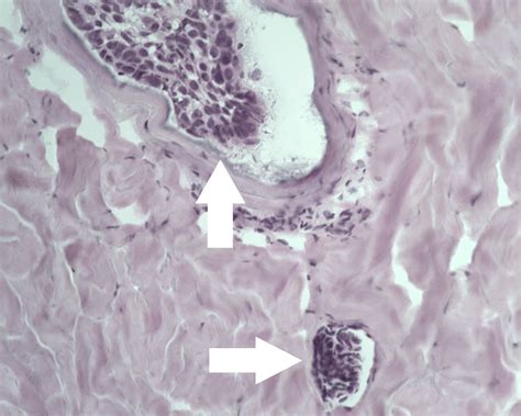 Cureus Metatypical Basal Cell Carcinoma With Intravascular Invasion