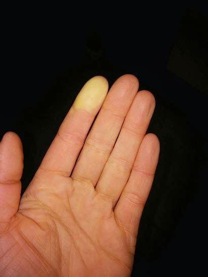 Need Help with Raynaud's? | Defying Lupus