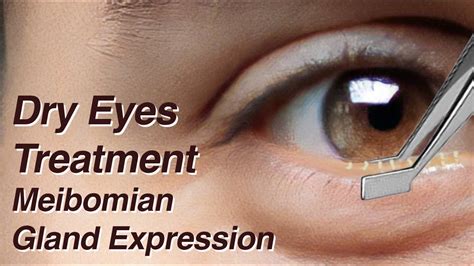 Dry Eyes Treatment With Meibomian Gland Expression Mgd