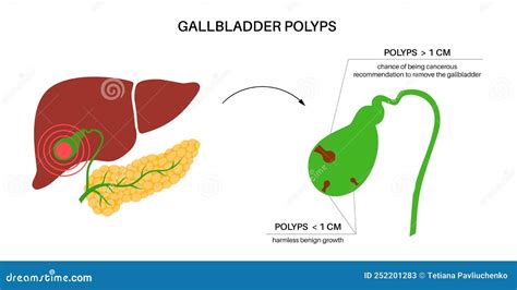 Gallbladder Polyp Anatomy Cartoon Vector 252201283