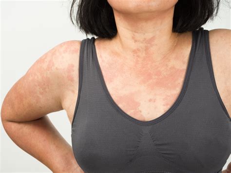 Can Anxiety Cause Rashes Balmonds