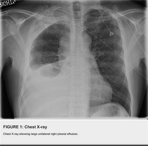 Figure 1 From A Rare Case Of Malignant Pleural Mesothelioma In A Young