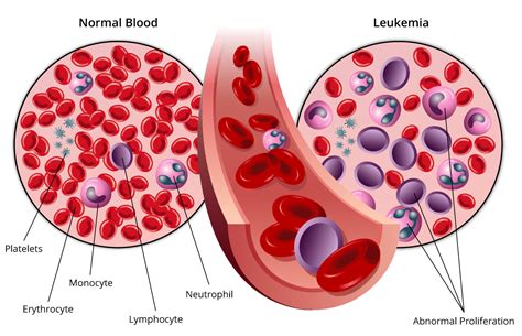 1 Leukemia Best Symptoms And Causes